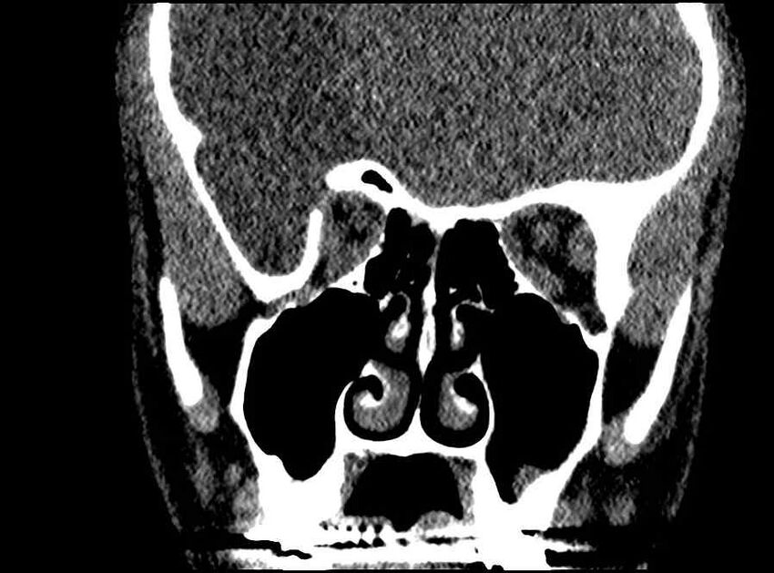 Arachnoid cyst- extremely large (Radiopaedia 68741-78450 Coronal bone window 42).jpg