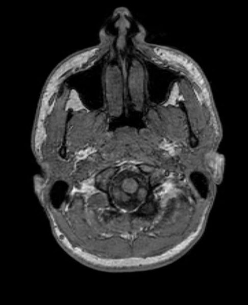 File:Arachnoid cyst- extremely large (Radiopaedia 68741-78451 Axial T1 8).jpg