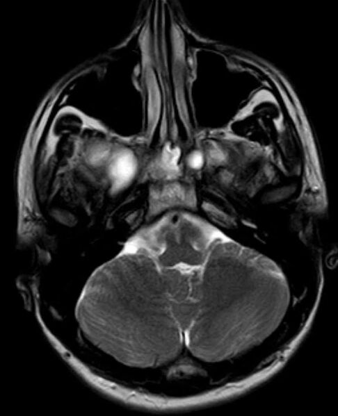 File:Arachnoid cyst- extremely large (Radiopaedia 68741-78451 Axial T2 6).jpg
