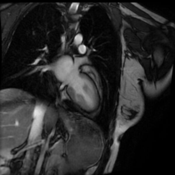 File:Arrhythmogenic right ventricular cardiomyopathy (Radiopaedia 87505-103850 2ch (LV) Cine SSFP 49).jpg
