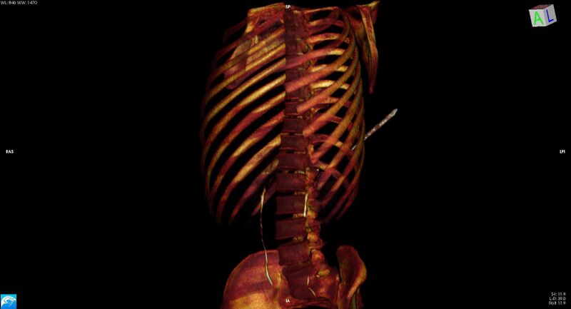 File:Arrow injury to the chest (Radiopaedia 75223-86321 3D bone 7).jpg
