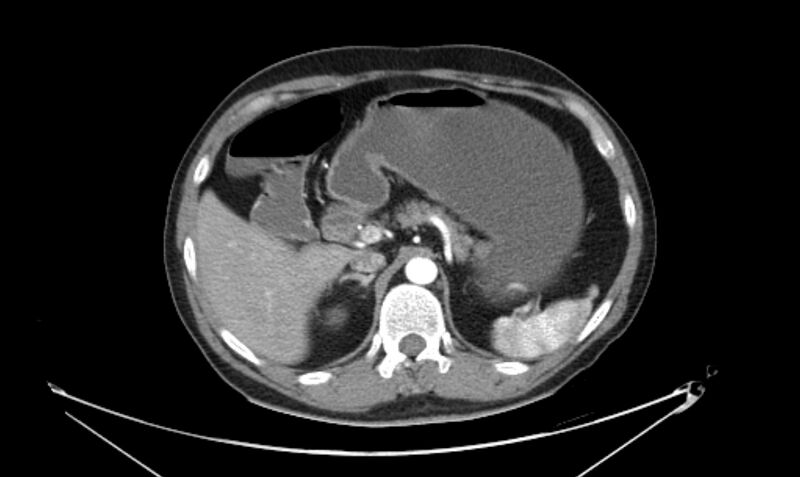 File:Arterial occlusive mesenteric ischemia (Radiopaedia 84641-100060 A 43).jpg
