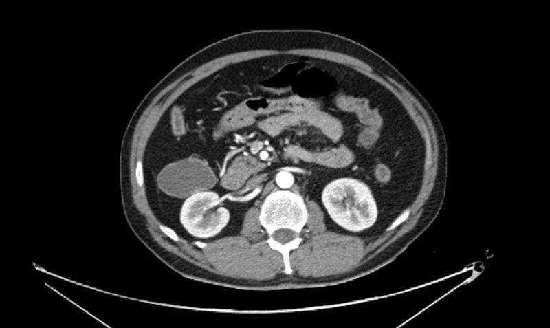 File:Arterial occlusive mesenteric ischemia (Radiopaedia 84641-100060 A 56).jpg