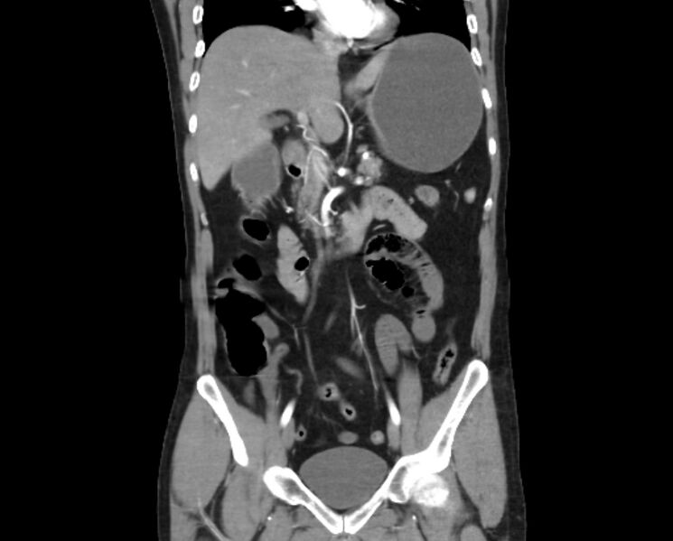 File:Arterial occlusive mesenteric ischemia (Radiopaedia 84641-100060 B 26).jpg