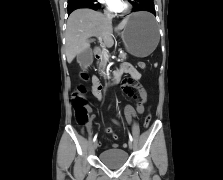 Arterial occlusive mesenteric ischemia (Radiopaedia 84641-100060 B 26).jpg