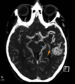 Arteriovenous malformation - cerebral (Radiopaedia 8172-14683 Figure 3 1).png