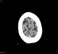 Arteriovenous malformation - cerebral (Radiopaedia 8172-9020 Axial non-contrast 23).jpg