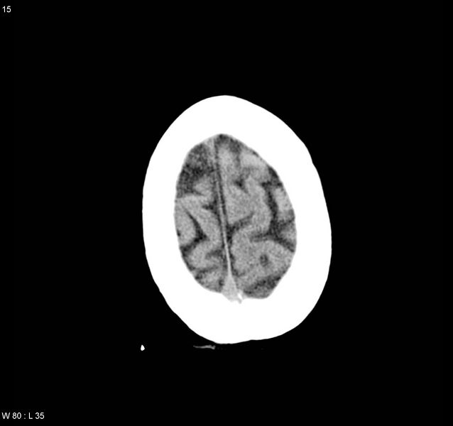 File:Arteriovenous malformation - cerebral (Radiopaedia 8172-9020 Axial non-contrast 23).jpg