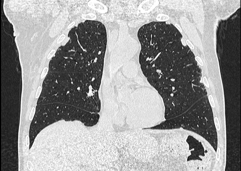 File:Asbestos pleural placques (Radiopaedia 57905-64872 Coronal lung window 113).jpg