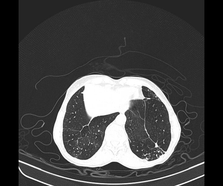 File:Aspergillomas (Radiopaedia 66779-76110 Axial lung window 41).jpg