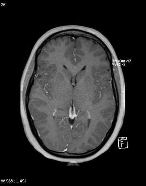 File:Astroblastoma (Radiopaedia 39792-42217 Axial T1 C+ 25).jpg