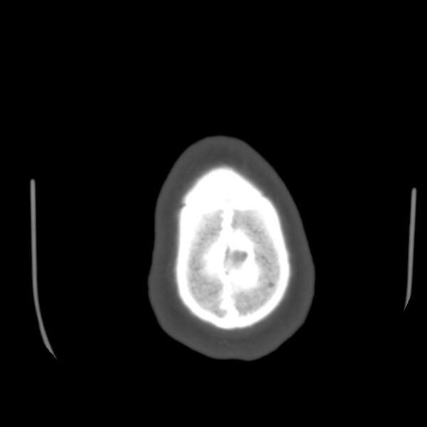 File:Asymptomatic occipital spur (Radiopaedia 87753-104201 Axial bone window 208).jpg