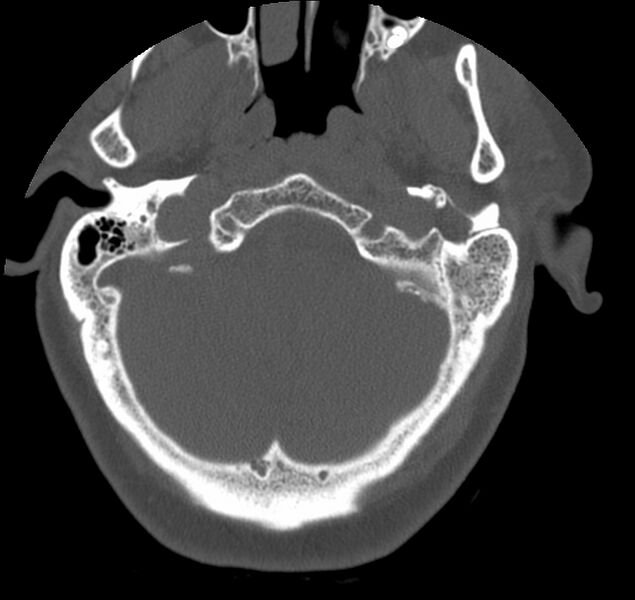 File:Atlanto-occipital assimilation with basilar invagination (Radiopaedia 70122-80188 Axial bone window 1).jpg