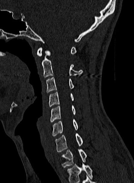 File:Atlantoaxial subluxation (Radiopaedia 44681-48450 Sagittal bone window 58).jpg