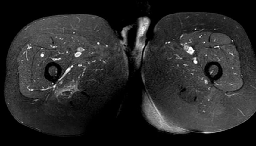 Atypical lipomatous tumor - thigh (Radiopaedia 68975-78734 Axial T1 C+ fat sat 67).jpg