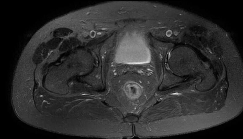 Atypical lipomatous tumor - thigh (Radiopaedia 68975-78734 Axial T2 fat sat 91).jpg