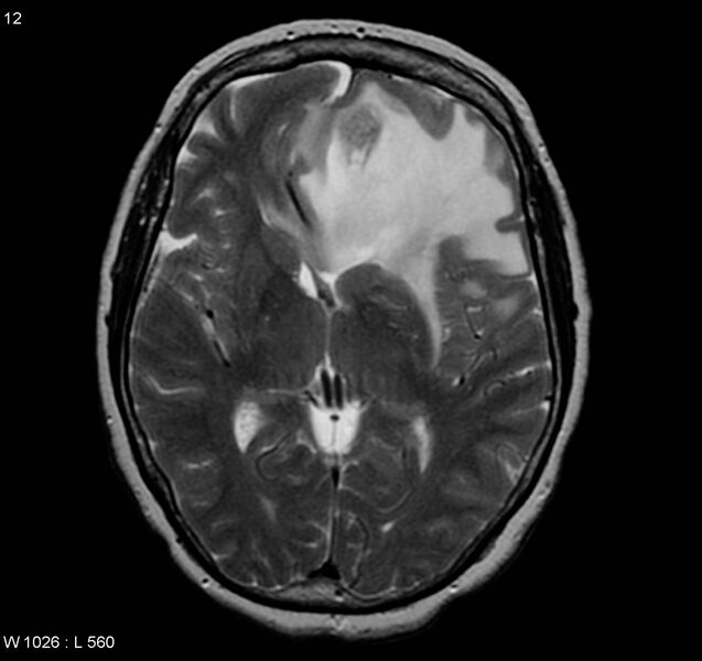 File:Atypical meningioma (WHO grade II) (Radiopaedia 5273-7016 Axial T2 5).jpg