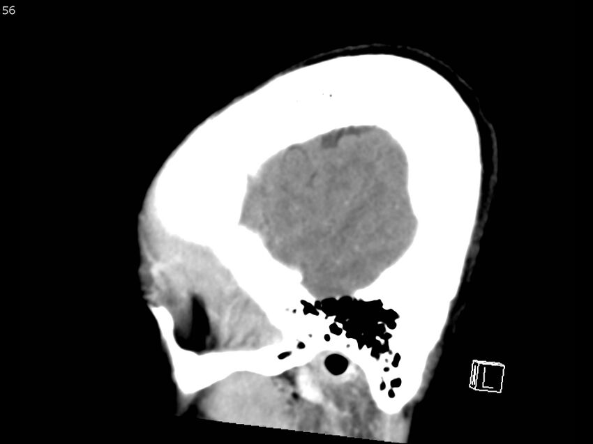 Atypical meningioma - intraosseous (Radiopaedia 64915-73867 F 55).jpg