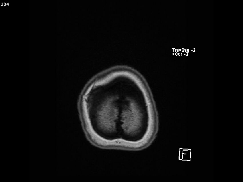 Atypical meningioma - intraosseous (Radiopaedia 64915-74572 Axial T1 184).jpg