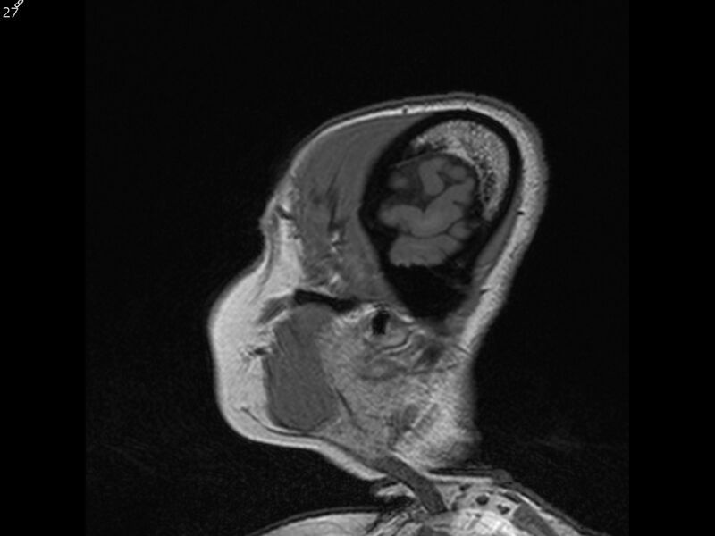 File:Atypical meningioma - intraosseous (Radiopaedia 64915-74572 Sagittal T1 27).jpg