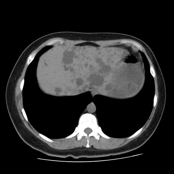 File:Autosomal dominant polycystic kidney disease (Radiopaedia 23061-23093 Axial non-contrast 7).jpg