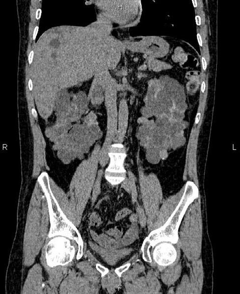 File:Autosomal dominant polycystic kidney disease (Radiopaedia 87830-104287 Coronal non-contrast 31).jpg