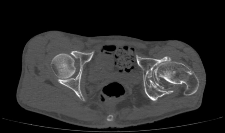 Avascular necrosis of the left hip (Radiopaedia 75068-86125 Axial bone window 52).jpg
