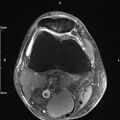 Avulsion fracture of the fibular head (Radiopaedia 74804-85808 Axial PD fat sat 9).jpg