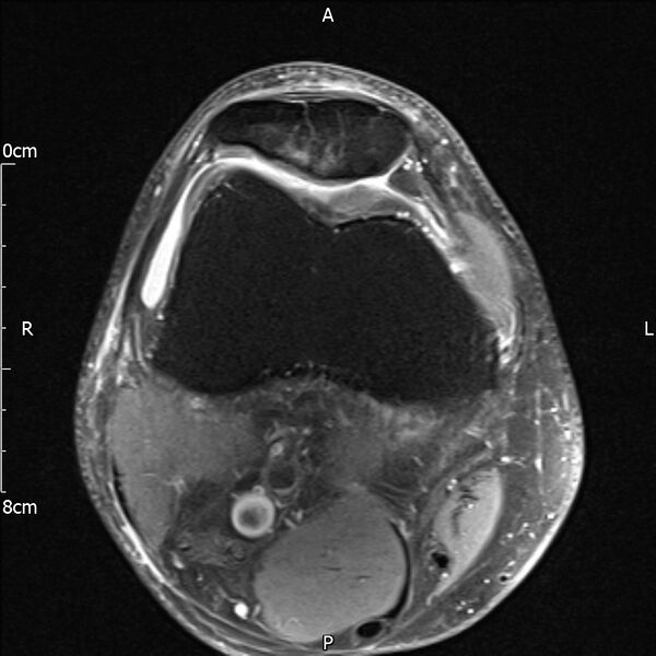 File:Avulsion fracture of the fibular head (Radiopaedia 74804-85808 Axial PD fat sat 9).jpg