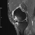 Avulsion fracture of the fibular head (Radiopaedia 74804-85808 Sagittal PD fat sat 11).jpg