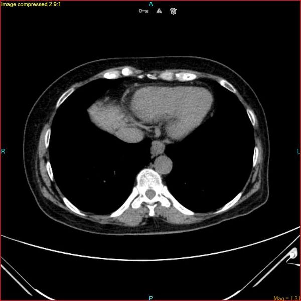 File:Azygos vein aneurysm (Radiopaedia 77824-90130 A 43).jpg