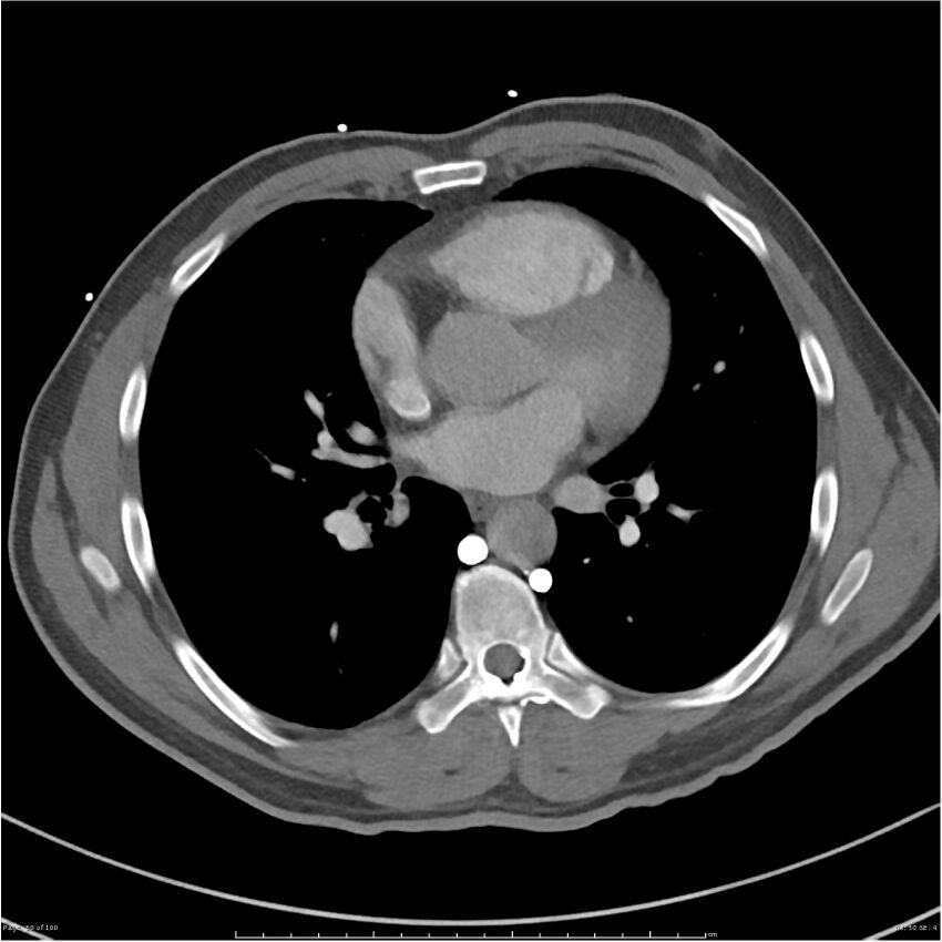 Azygos venous system anatomy (CT pulmonary angiography) (Radiopaedia 25928-26077 Axial C+ CTPA 50).jpg