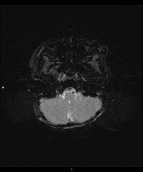 File:Basal ganglia and parenchymal ischemia (Radiopaedia 45818-50084 Axial SWI 6).jpg