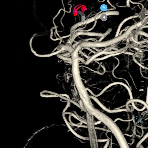File:Basilar artery perforator aneurysm (Radiopaedia 82455-97734 3D view left VA 31).jpg