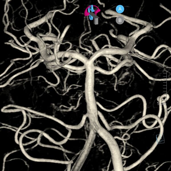File:Basilar artery perforator aneurysm (Radiopaedia 82455-97734 3D view left VA 43).jpg