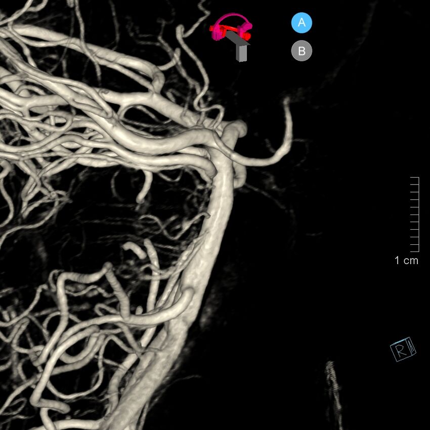 Basilar artery perforator aneurysm (Radiopaedia 82455-97734 3D view left VA 61).jpg