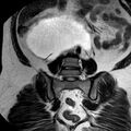 Benign seromucinous cystadenoma of the ovary (Radiopaedia 71065-81300 F 22).jpg