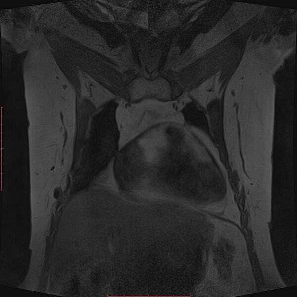 File:Bilateral breast implant rupture (Radiopaedia 24761-25027 G 16).jpg