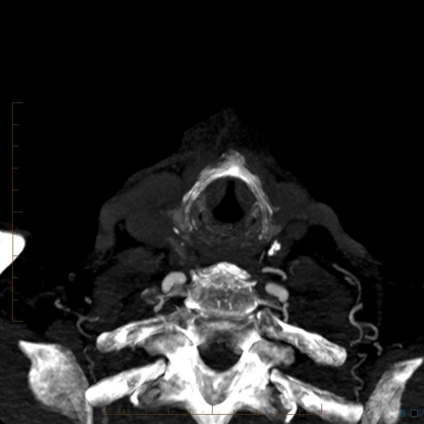 Bilateral chronic common carotid occlusion (Radiopaedia 50849-56362 D 47).jpg