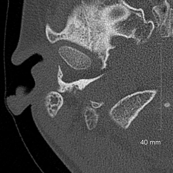 File:Bilateral grommets (Radiopaedia 47710-52404 Axial bone window 10).jpg