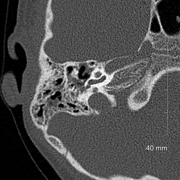 File:Bilateral grommets (Radiopaedia 47710-52404 Axial bone window 35).jpg
