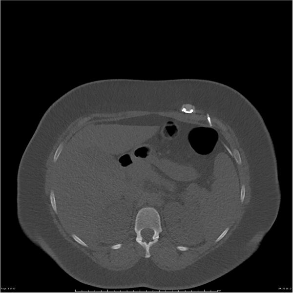 File:Bilateral lumbar ribs (Radiopaedia 25862-26010 bone window 6).jpg