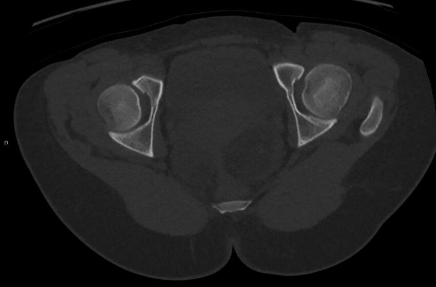 Bilateral mature cystic ovarian teratoma (Radiopaedia 88821-105592 Axial bone window 45).jpg