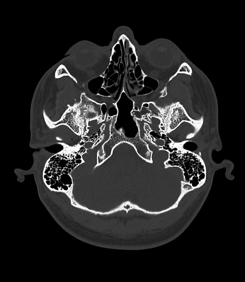 Bilateral medial canal fibrosis (Radiopaedia 85598-101344 Axial bone window 10).jpg