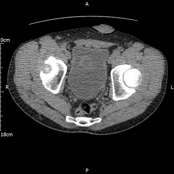 File:Bilateral medullary nephrocalcinosis with ureteric calculi (Radiopaedia 71269-81569 Axial non-contrast 120).jpg
