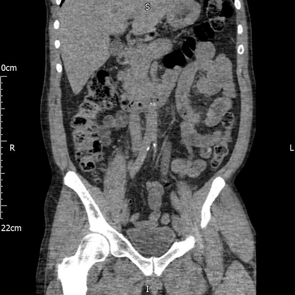 File:Bilateral medullary nephrocalcinosis with ureteric calculi (Radiopaedia 71269-81569 Coronal non-contrast 29).jpg
