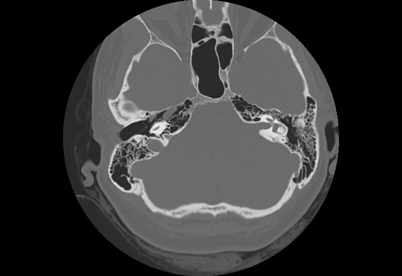 File:Bilateral otospongiosis (Radiopaedia 35447-36940 Axial bone window 27).jpg