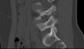 Bilateral pars defect (Radiopaedia 26691-26846 Sagittal bone window 21).jpg