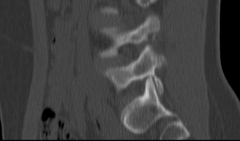 File:Bilateral pars defect (Radiopaedia 26691-26846 Sagittal bone window 21).jpg