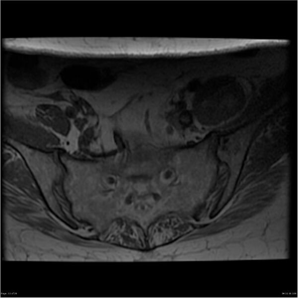 File:Bilateral psoas hematomas (Radiopaedia 24057-24280 T1 11).jpg